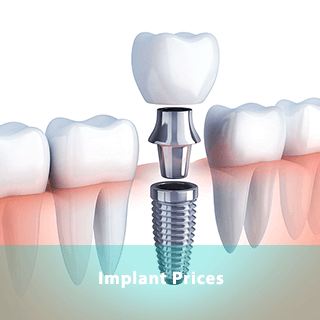 https://dentway.fr/wp-content/uploads/2019/10/implant.png