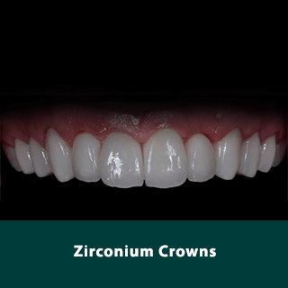 https://dentway.fr/wp-content/uploads/2019/10/zirkonium-dentway.png